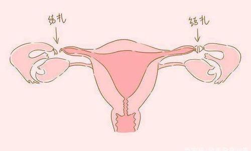 结扎了还能去哈萨克斯坦做第三代试管婴儿吗？