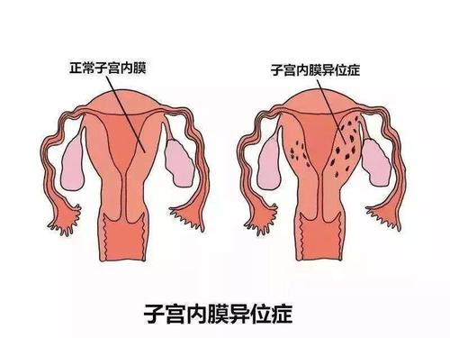 贝安：子宫内膜异位症是哪些原因造成的？