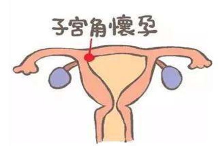 贝安健康：发生宫角妊娠该怎么处理？