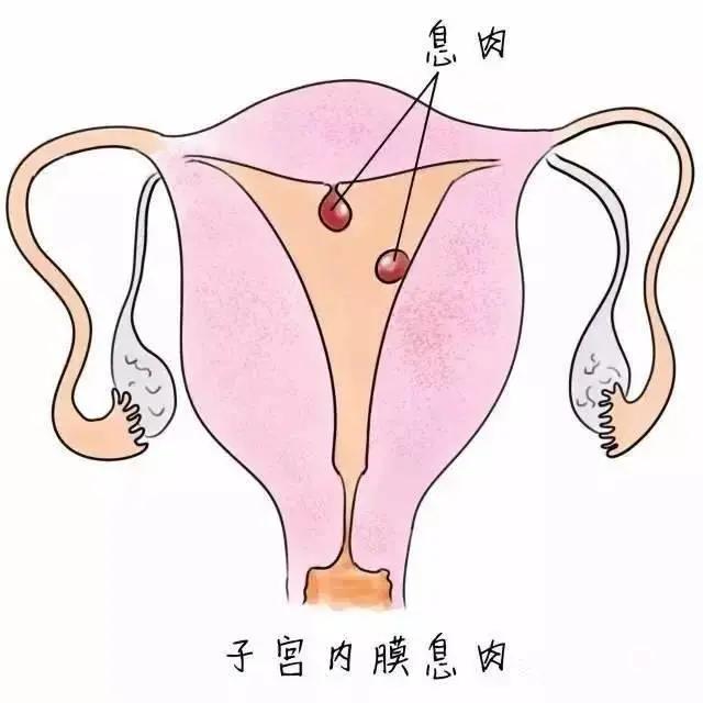 贝安健康:子宫内膜息肉摘除后要怎么防止复发?