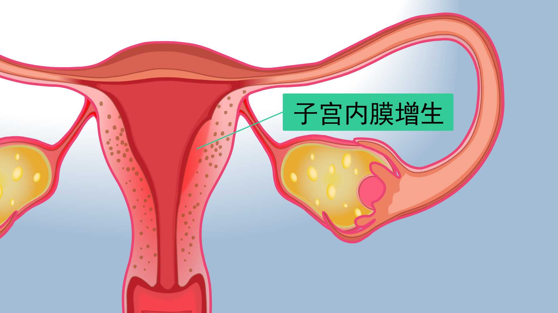 贝安健康：子宫内膜增生可以根治吗？