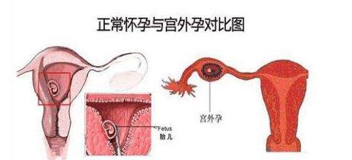 贝安健康怎么判断是否宫外孕