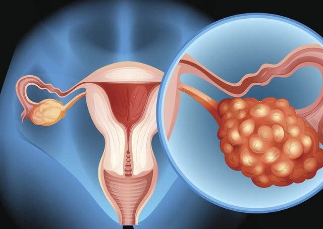 贝安健康:卵巢囊肿有哪些症状?