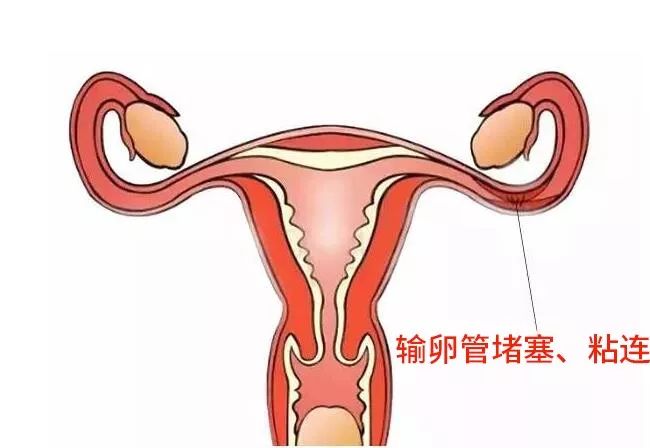 贝安健康：什么是输卵管性不孕?