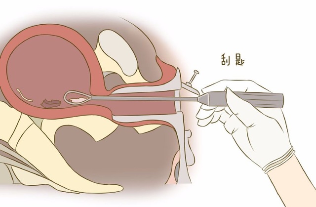 贝安健康刮宫对女性身体有什么影响